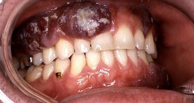 I sottoprodotti dei batteri parodontali possono indurre la crescita del cancro orale