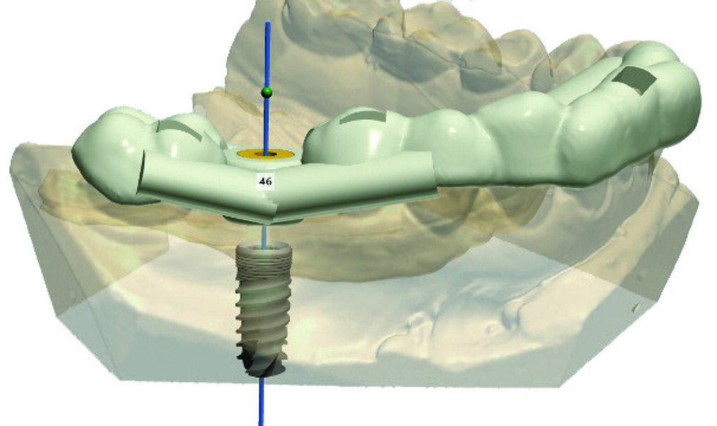 Fig. 9 : Positionnement de la douille MIS correspondant à l’implant choisi. 