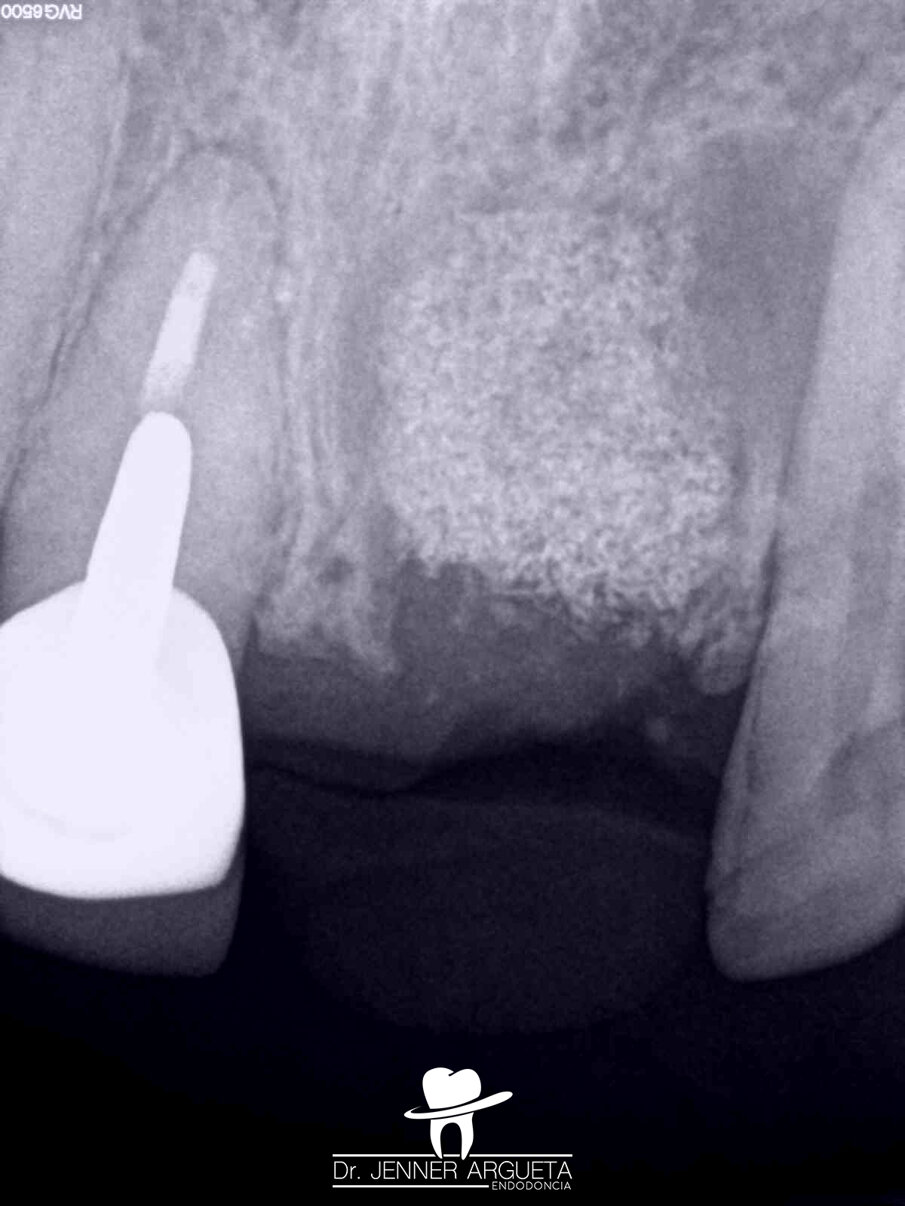 Fig. 10: Bone grafting material placed at the extraction site of tooth #21.