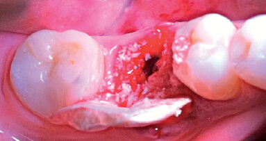 Rigenerazione dei tessuti molli perimplantari: case report