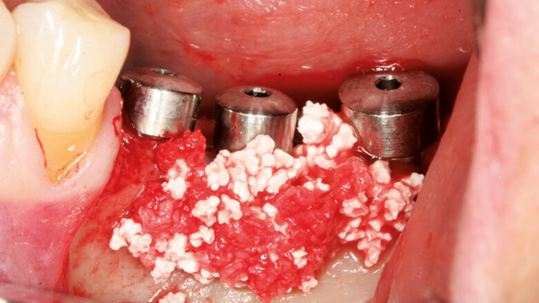 Řízená kostní regenerace  kolem implantátů s periimplantátovými kostními defekty