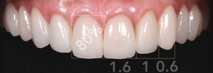 Slika 2.b Analiza zubi