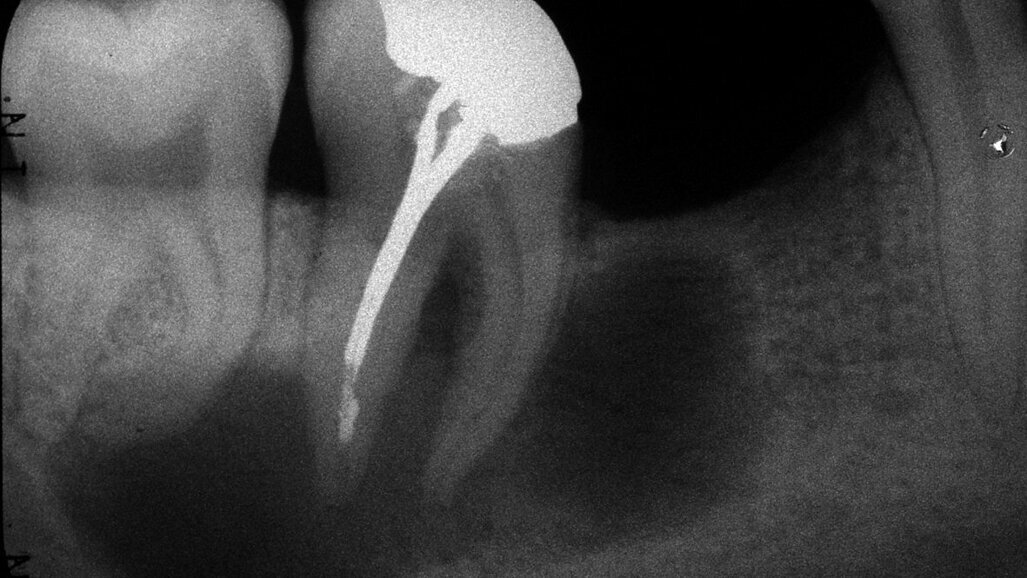 Retraitement endodontique : traiter ou ne pas traiter ?