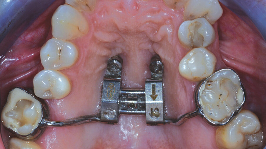 Figg. 1a, 1b_Utilizzo di dispositivi ausiliari (REP su miniviti nella foto a sinistra e bottoni linguali con trazione elastica nella foto di destra) per aumentare la predicibilità dei trattamenti con allineatori dentali ALLEO.