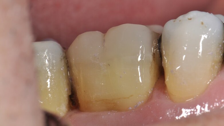Refuerzo directo complejo de dentina pericervical sometida a tratamiento endodóntico