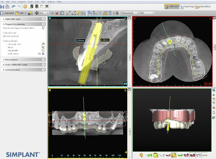 Fig. 4: Designing the guide in the Simplant software based on the planned implant position.