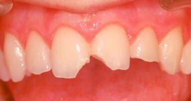 Il punto di vista dell’odontologo forense nella valutazione dei traumi dentali