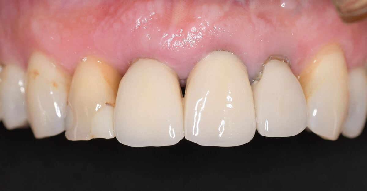 Implant placement with totally guided virtual workflow