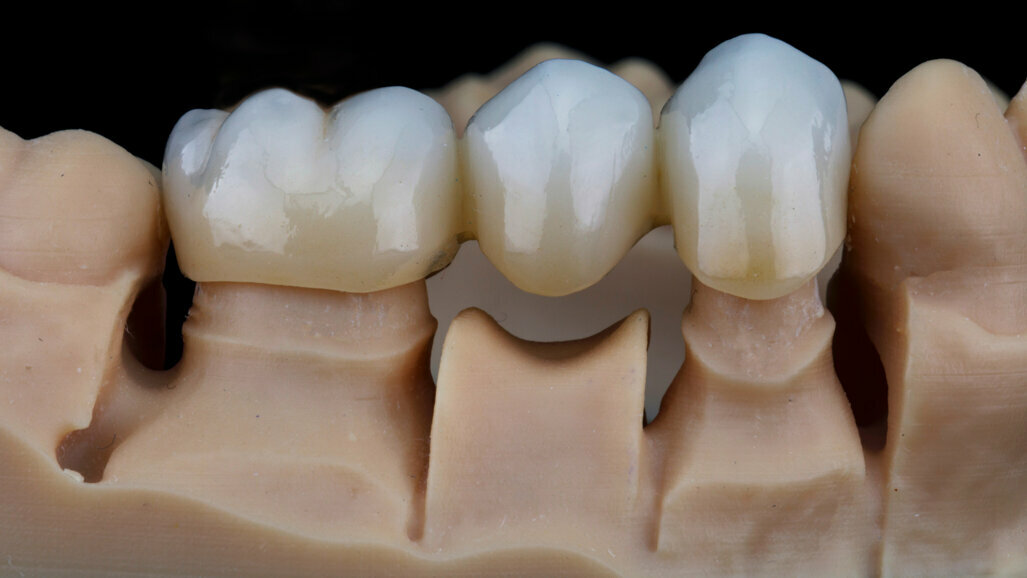 H3D busca remediar escassez de técnicos com AI CAD para laboratórios de prótese dentária