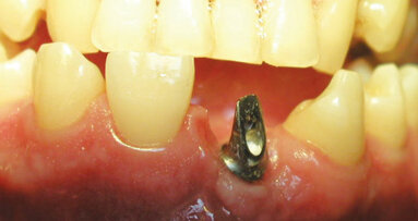10 rules of order in implantology