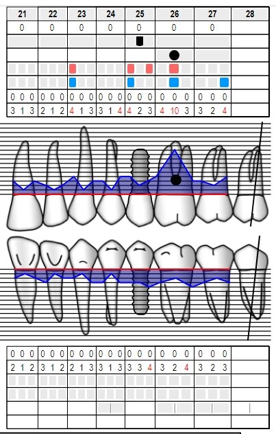 Fig. 2 - Sondaggio parodontale preoperatorio.