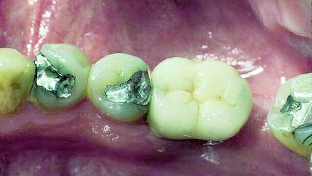 Restauration d’une molaire unitaire – Implant de large diamètre versus deux implants conventionnels