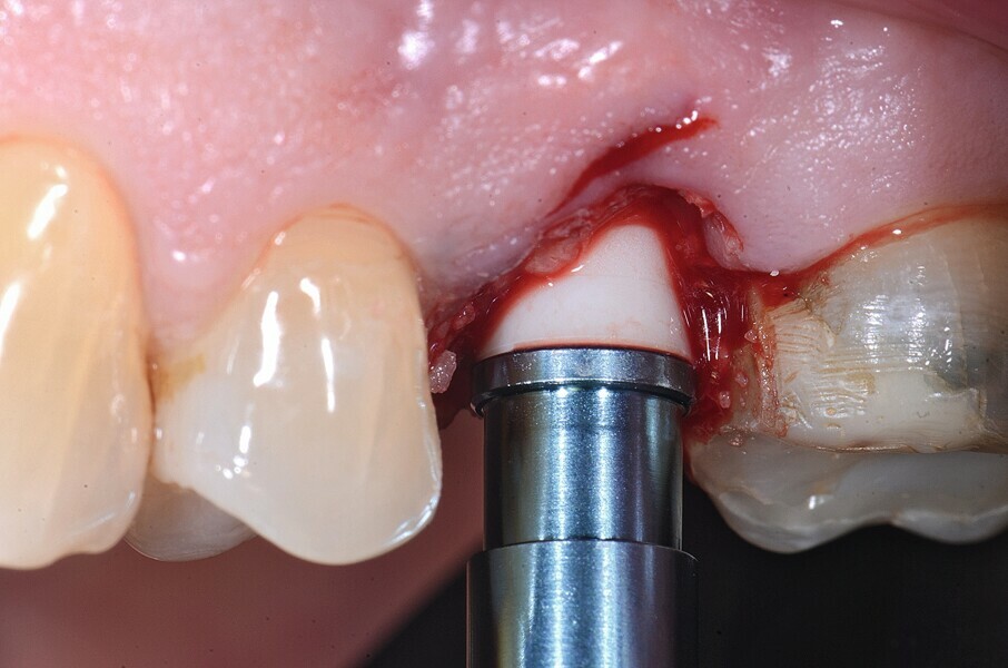 Fig. 18 : Pose de l’implant deux pièces en céramique au niveau tissulaire.