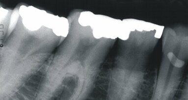 Les radiographies dentaires peuvent prédire les fractures