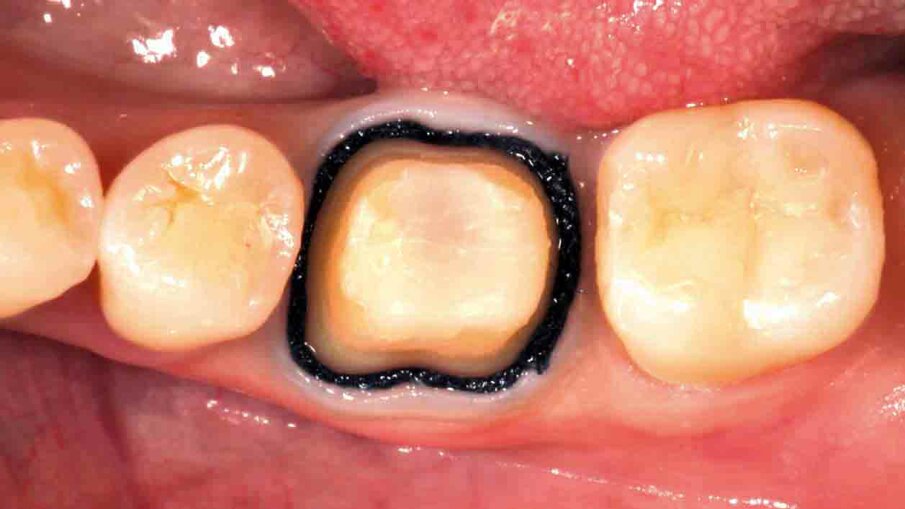 Fig. 6:  In order to allow for a detailed capture of the preparation margin, the gingival tissues are retracted using the double-cord technique. Alternatively, a single cord may be applied in combination with  3M™ Astringent Retraction Paste.