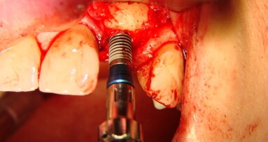 Rekonstrukcja blokiem allogennym wyrostka zębodołowego w okolicy 22 i wszczepienie implantu BEGO Semados S