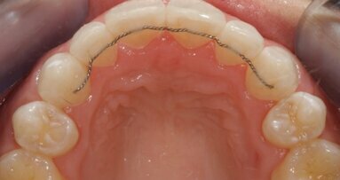 The Inman Aligner: Alignment, bleaching and bonding—A progressive approach to smile design (Part II)