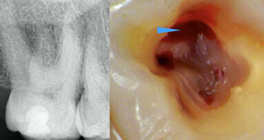 Clinical management of maxillary second molar root canal therapy in different anatomical situations