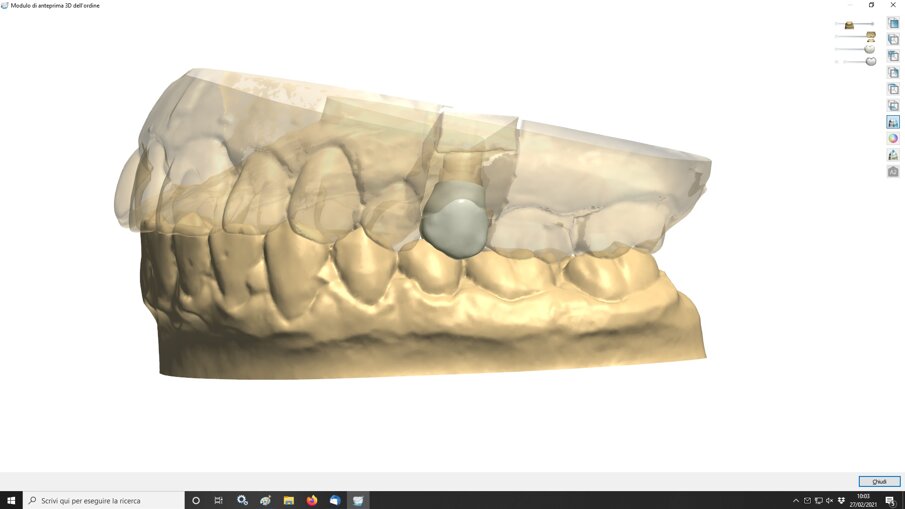 Fig. 10_In laboratorio l’odontotecnico dopo aver trasferito l’impronta provvede alla sua acquisizione tramite uno scanner, potendo così proseguire nel progetto realizzativo di una ricostruzione protesica in zirconia.