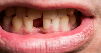 Tupakoinnin lopettaminen saattaa vähentää hampaiden menettämisen riskiä