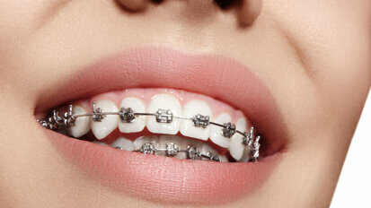 New adhesive prevents dental caries around orthodontic brackets