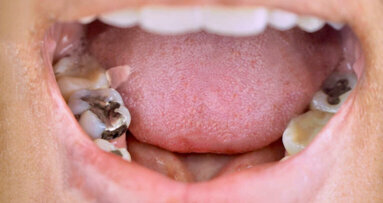 北アイルランドは歯科用アマルガムの段階的廃止を「実行不可能」とする