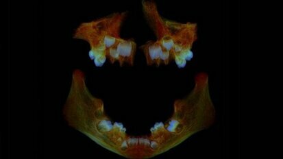 Dentes podem ajudar a identificar problemas de saúde modernos
