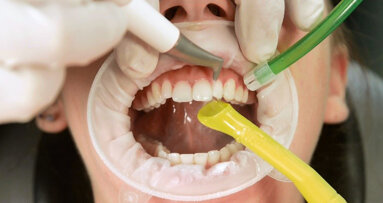 5 mýtů o pískování zubů, které nejsou pravdivé a přimějí Vás přehodnotit protokol dentální hygieny