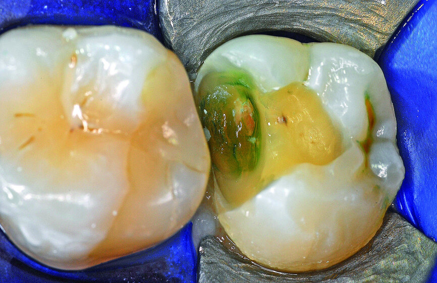 Fig. 15: Temporary filling material was removed and there was evidence of caries as indicated by a caries indicator solution.