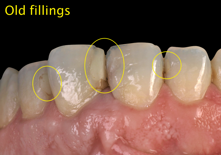 Fig. 2: Asymmetrical central incisors with old restorations on central and lateral incisors, tooth # 11,12 & 21, 22.