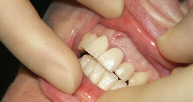 Dental implants can be successful with less root than crown