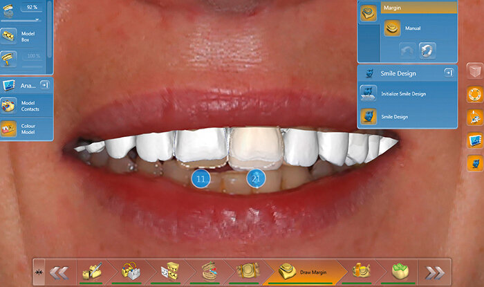 Fig. 8: With the CEREC-Smile Design Application, the restorations can be evaluated together with the lips.