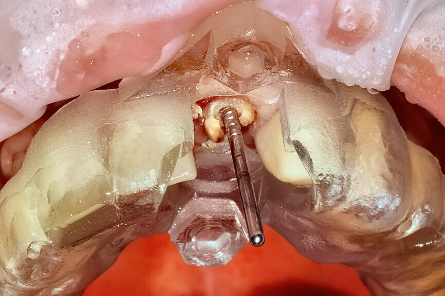 Fig. 17a: Utilising the tooth-borne template and the first insert, initial long shaper drills were used to reach the apex of the root.