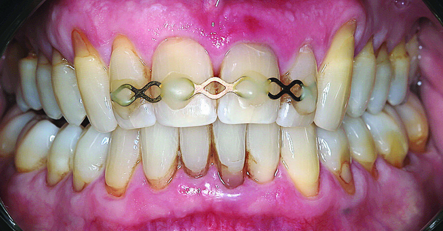 Slika 1. Početna situacija: Frontalni prikaz reponiranih i splintiranih zubi 11 i 21 