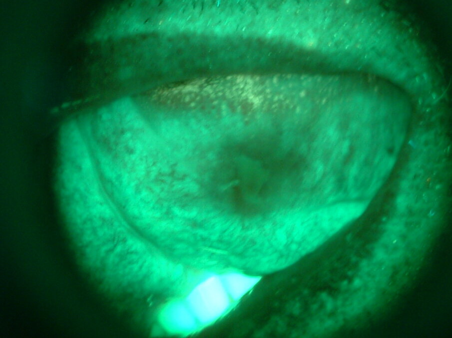 Fig. 3 - Paziente con perdita della fluorescenza nella lesione.