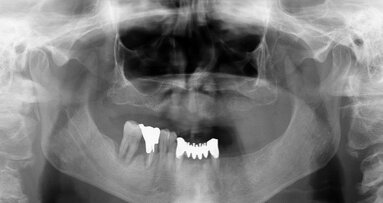 Riabilitazione implantoprotesica mandibolare immediata: un protocollo predicibile e ripetibile