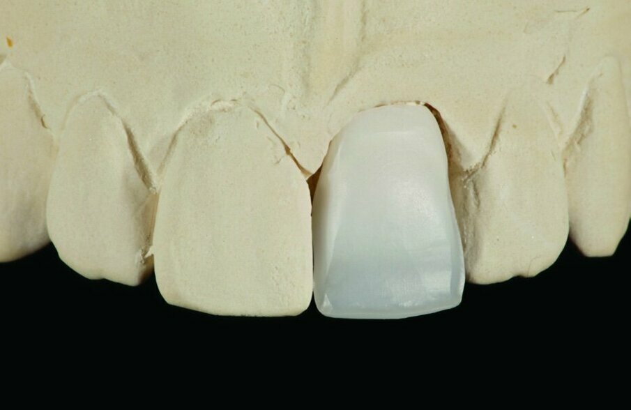 Fig. 3: The lightly reduced full-contour crown made with IPS e.max ZirCAD Prime shows excellent fit.