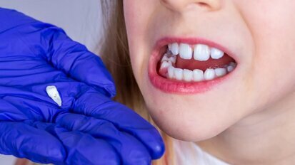 Růstové linie dočasných zubů mohou pomoci vyhodnotit riziko vzniku duševních poruch