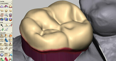 Designing multiple restoration types using one dental CAD/CAM system