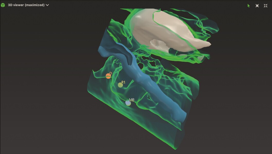 Fig. 15 : Reconstruction 3D montrant que le nerf contourne la zone vestibulaire et n’est en contact qu’avec la partie médiane du canal mésial.