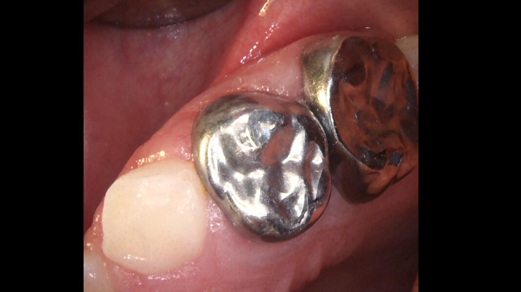 Fig. 23: Clinical aspect at final evaluation showing healthy gingival tissue.