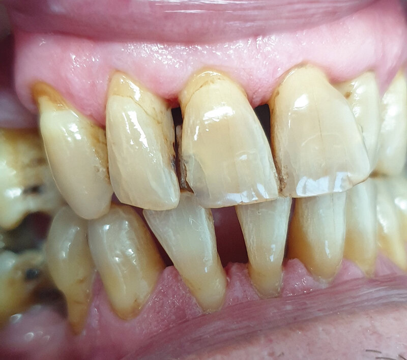 Sl. 2.1: Pacijent B, pušač nakon poliranja i beljenja zuba