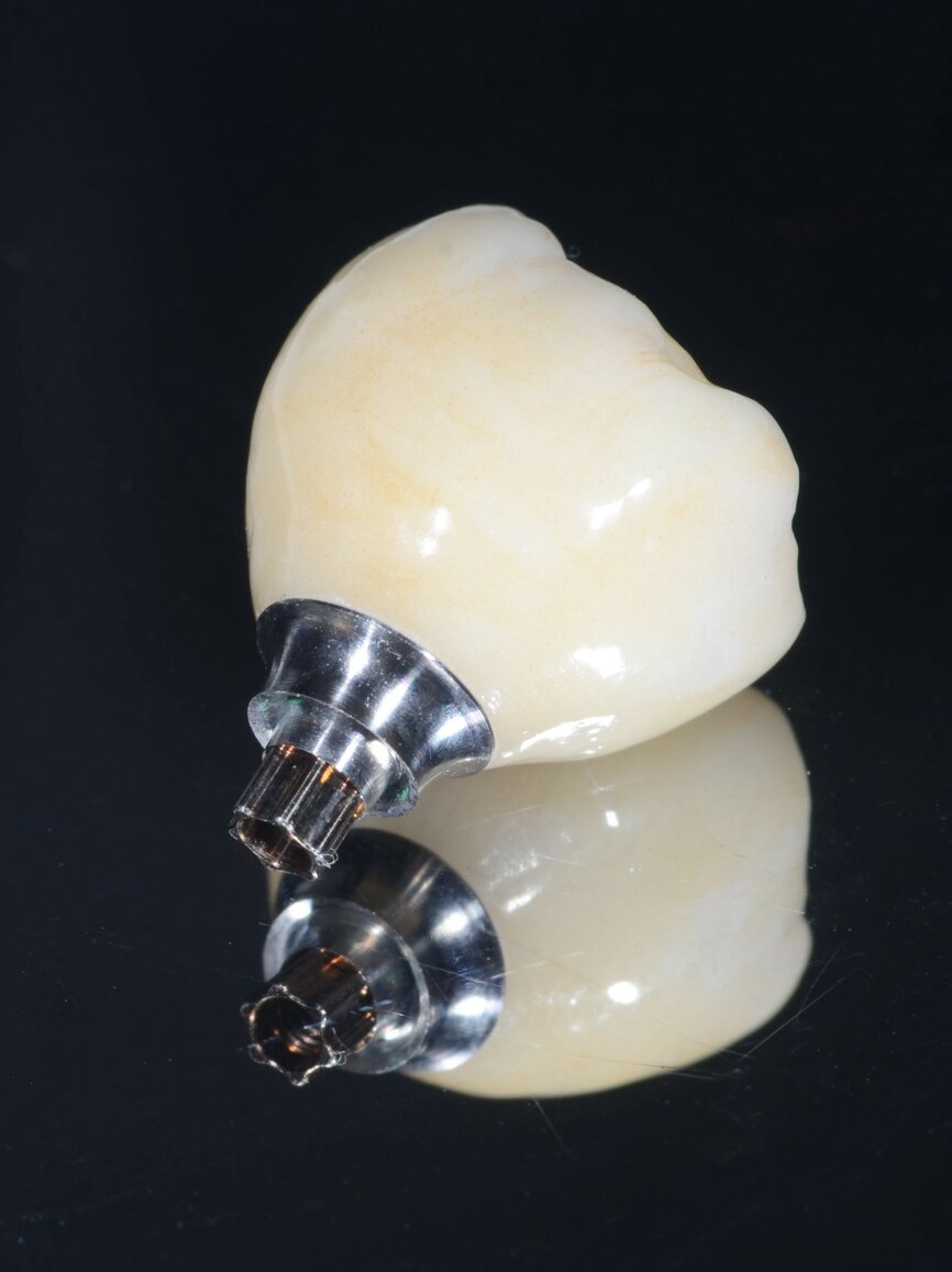 Fig. 11: Temporary PMMA crown on a wide base temporary titanium abutment.