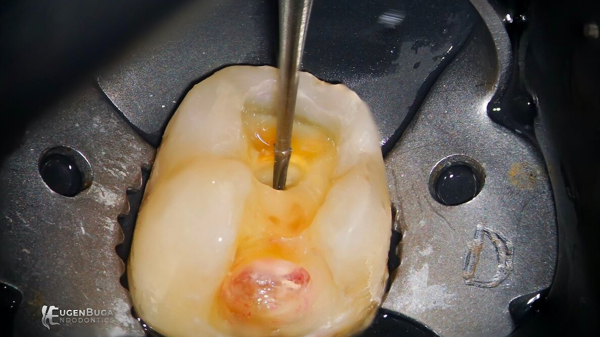 Guide to achieving fast and efficient precision in endodontics