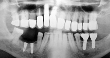 Impression of steeply angulated implants: A new method