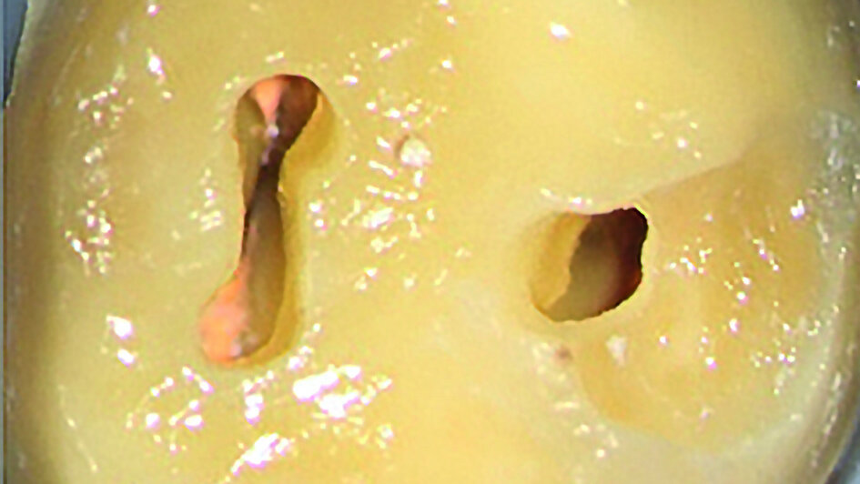 Préparer les cavités d’accès endodontique – Pour des résultats à long terme