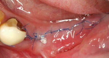 Nici chirurgiczne – typy i zastosowanie w chirurgii jamy ustnej