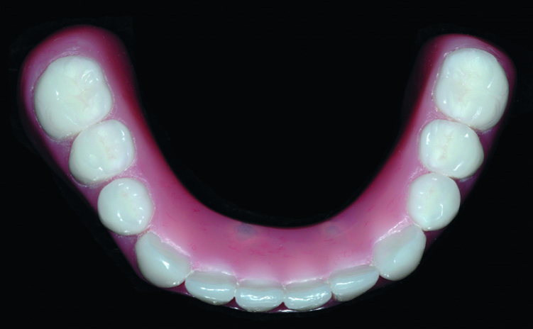 Fig. 16: Completed restoration. Note the absence of screw access holes for a prosthesis that looks like a denture yet fits like a bridge.