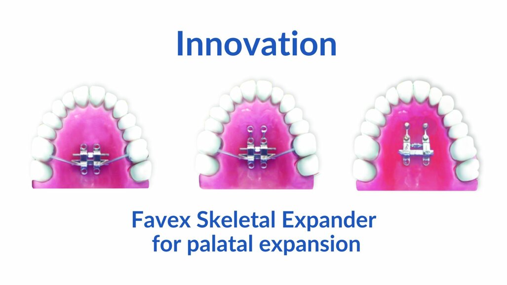 “Favex maxillary expander is patient-centric rather than appliance-centric”: Innovation