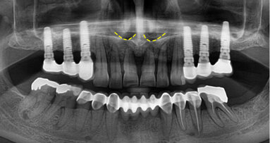 Kdy parodontolog předá pacienta implantologovi?